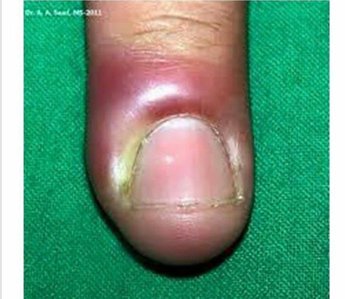 Most common cause medizzy
