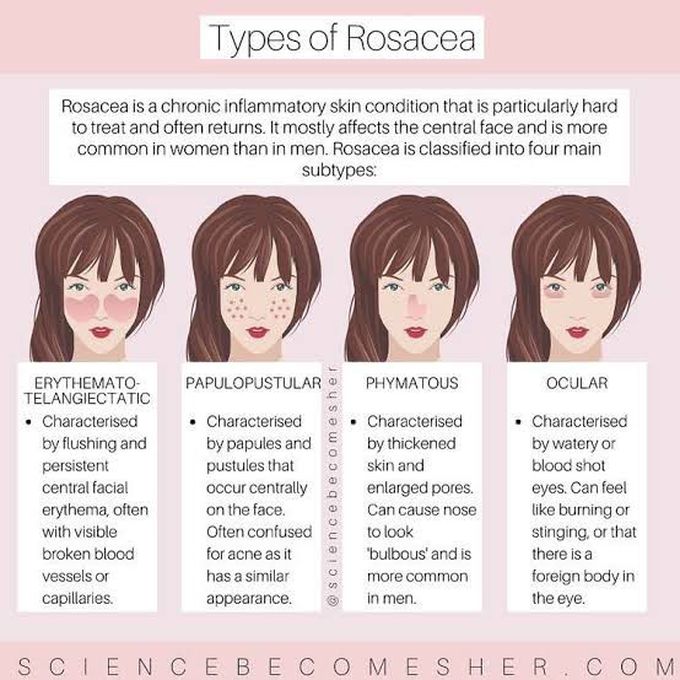 Types of Rosacea