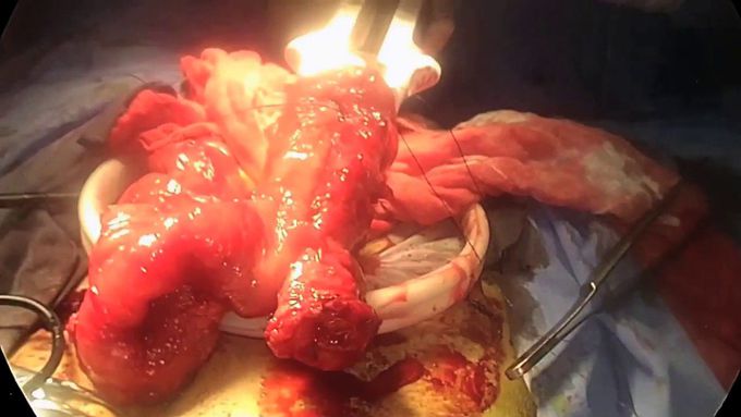 Proctectomy and IPAA for Ulcerative Colitis with Diffuse Enteritis after Colectomy