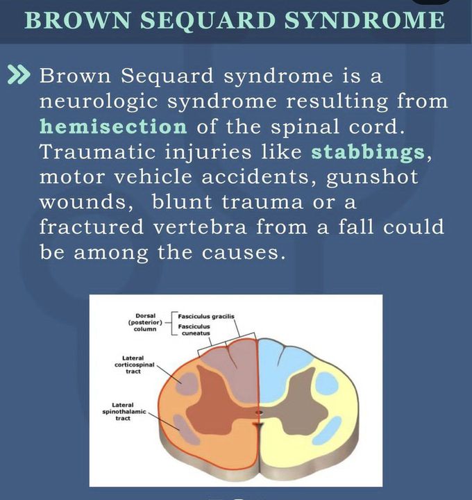 Brown Sequard Syndrome III - MEDizzy