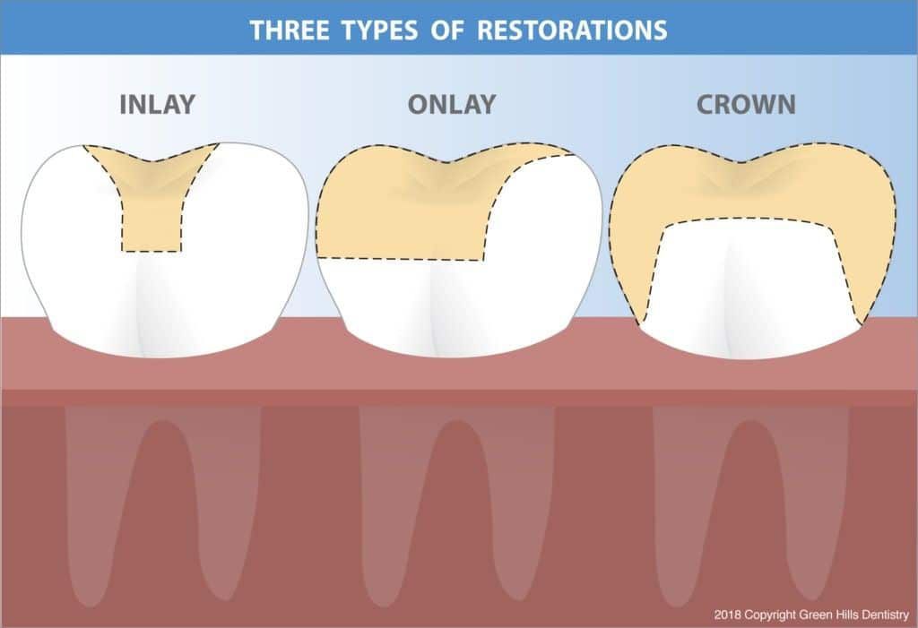 Inlay vs Onlay vs Crown - MEDizzy