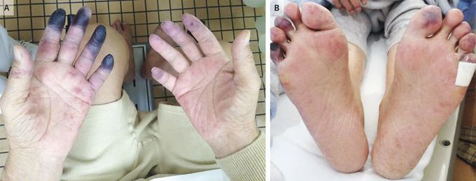 Necrosis of the Fingers and Toes