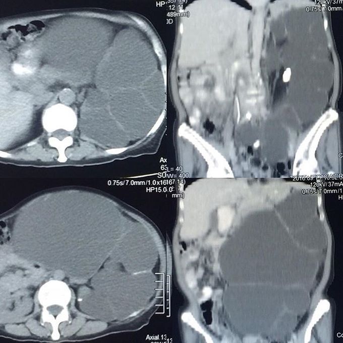 Hydronephrosis