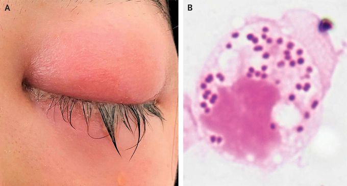 Ocular Gonorrhea