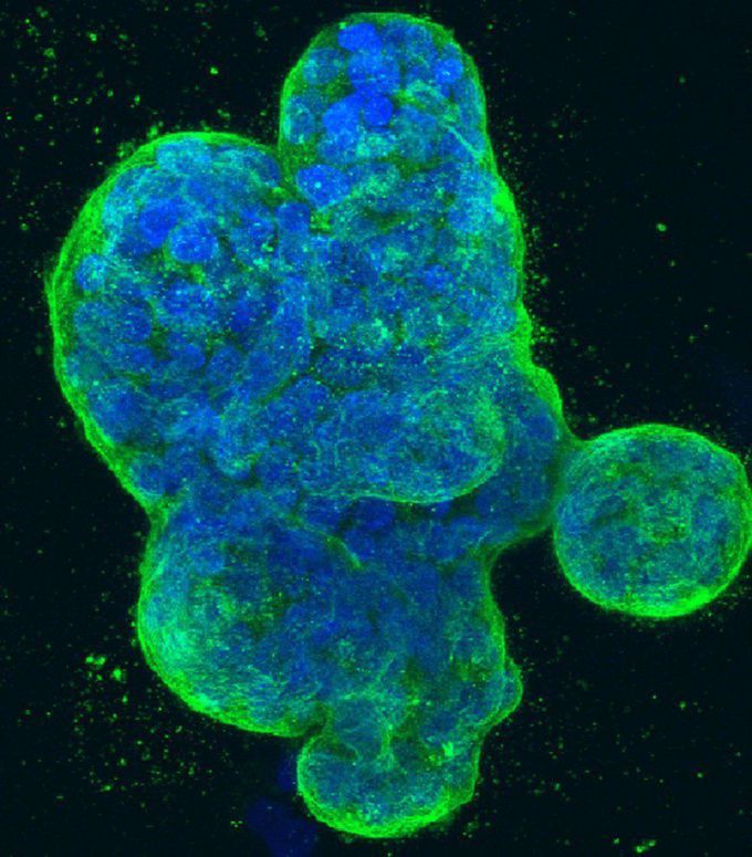 PARP inhibitor improves progression-free survival in patients with advanced breast cancers