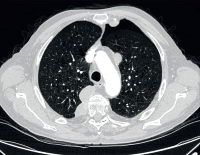 Cabozantinib-related pneumothorax in rapidly responding patients with renal cell carcinoma