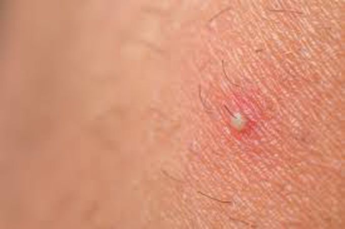 Cause of ingrown pubic hair