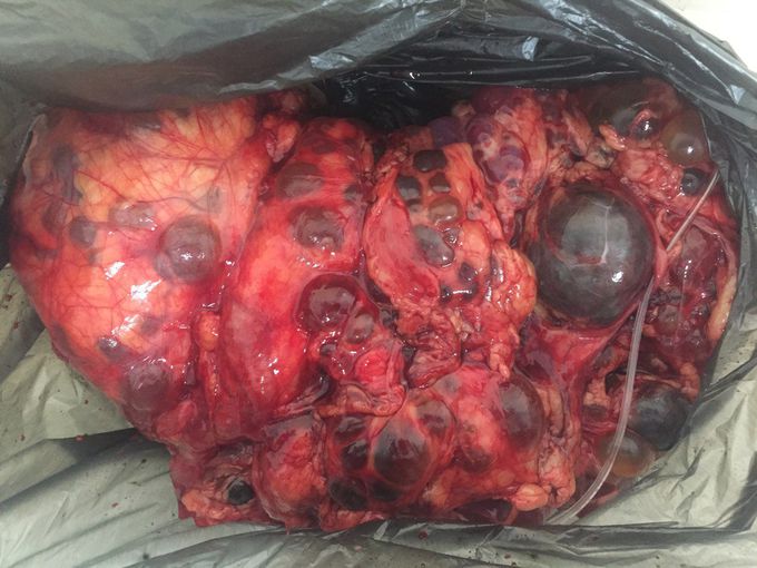 Horseshoe kidney polycystic desease