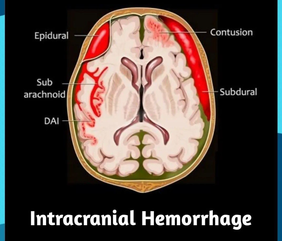 Intracranial Hemorrhage