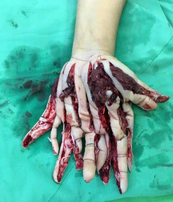 Case of a patient who got his hand stuck in an animal feed blender/shredder!!