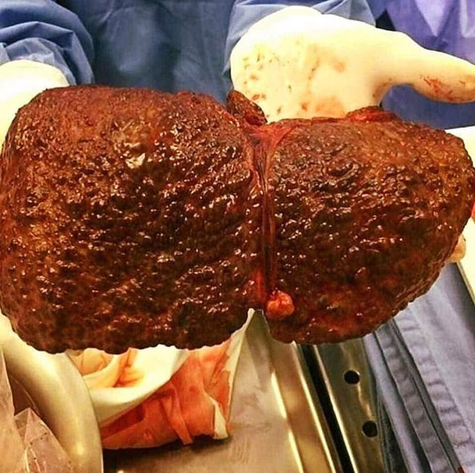 Here’s a liver cirrhosis showing multiple nodules on what was once a smooth surface!