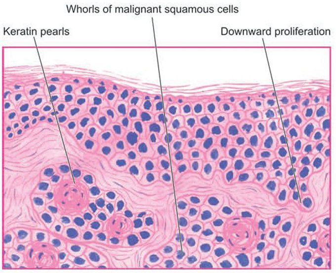 Microscopic features of well-differentiated squamous cell carcinoma.