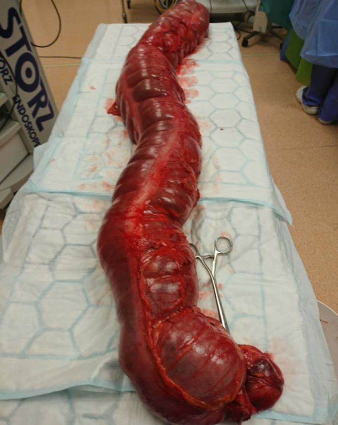 Removed part of a twisted bowel filled with gas! A condition called volvulus. 