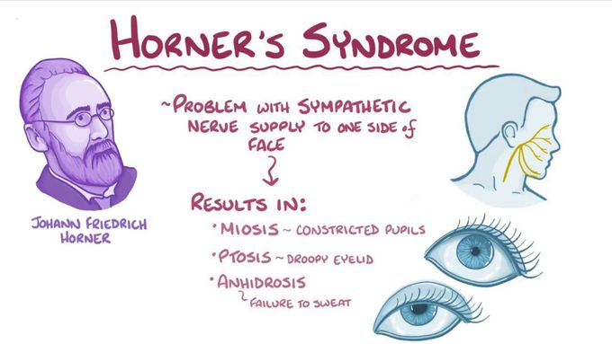 Treatment of horner syndrome