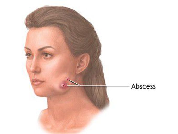 Symptoms of Actinimycosis