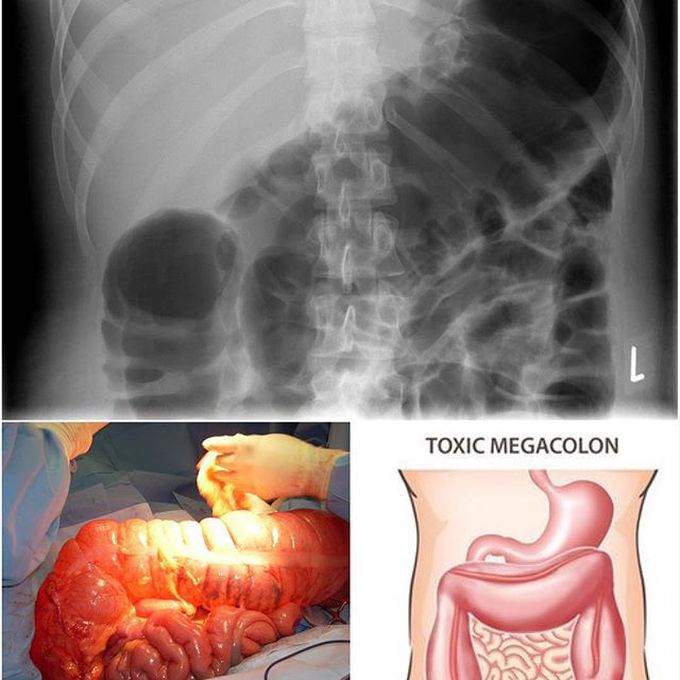 Toxic megacolon