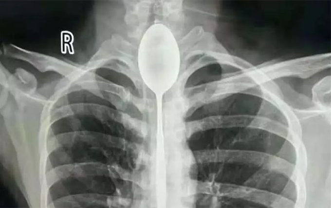 Chinese Man Had Steal Spoon Lodged In His Oesophagus For An Entire Year