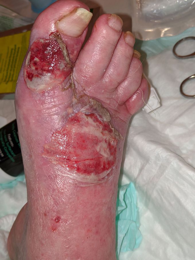 Damage from weeping edema