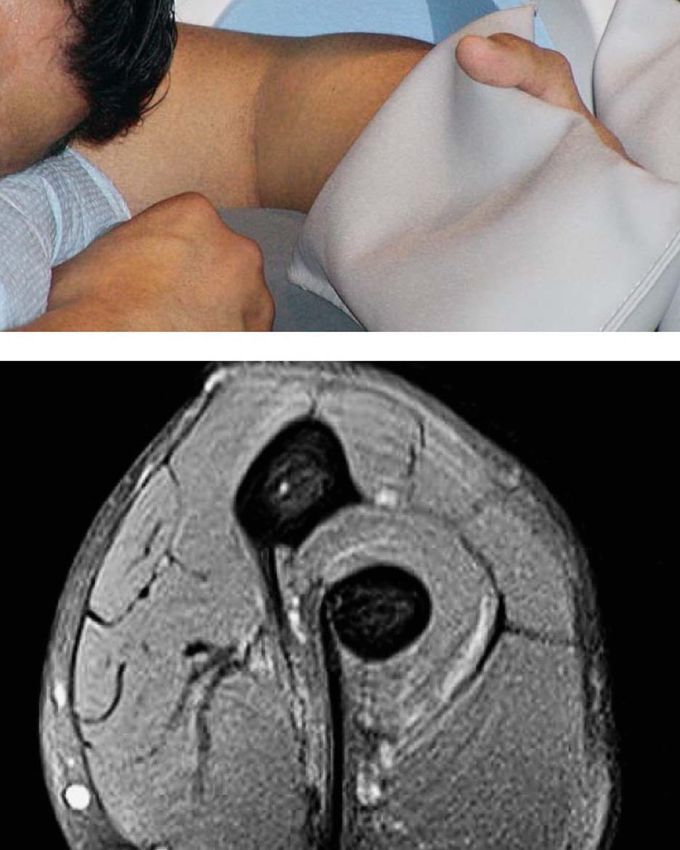 Pathologic conditions of the distal biceps brachii tendon