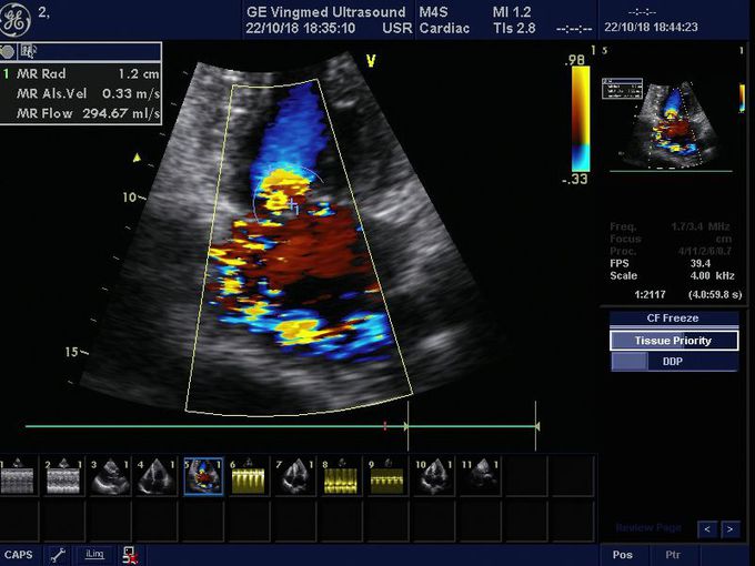 Mitral regurgitation