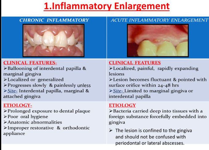 Enlargement of gingiva