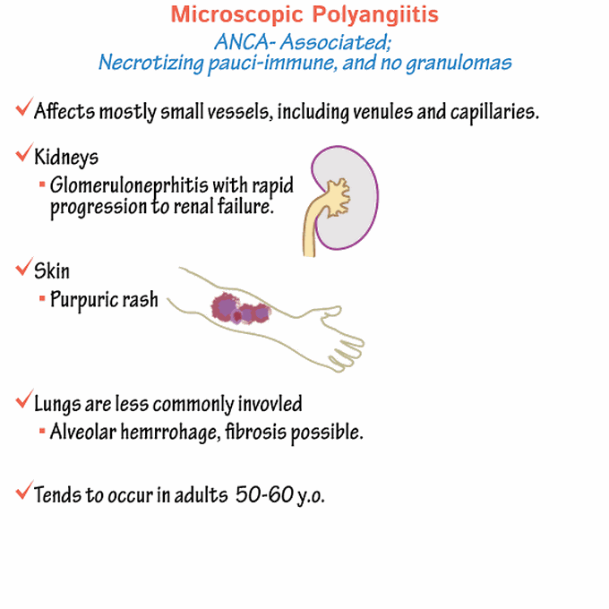 Microscopic Polyangiitis