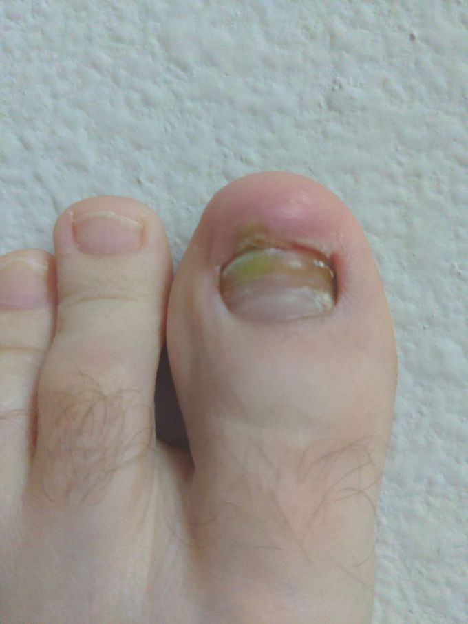 New growing toenail starting to become in-grown.