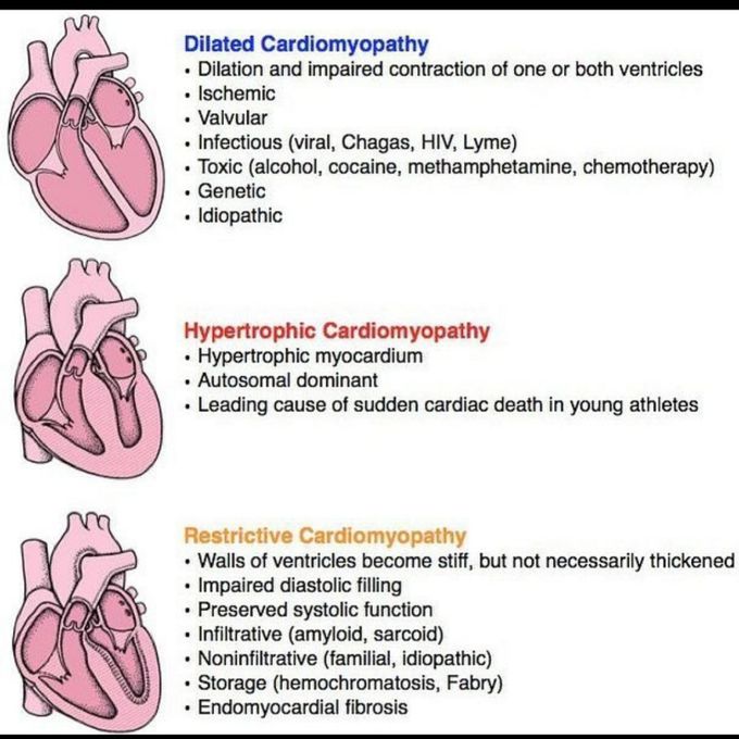 Cardiomyoopathy