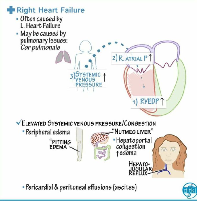 Right heart failure