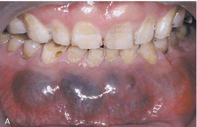 Glandular Odontogenic Cyst.