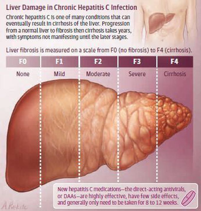Hepatitis C infection