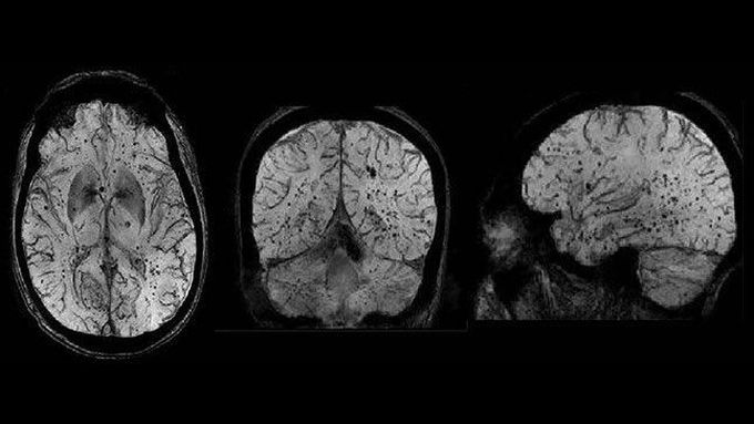 Susceptibility-weighted imaging
