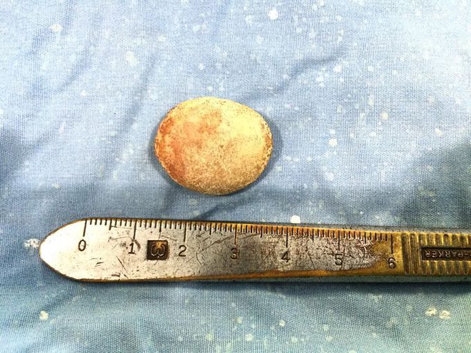 Bladder stone
