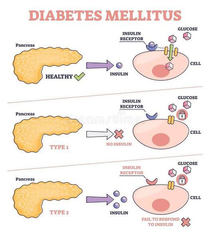 Diabetes Mellitus