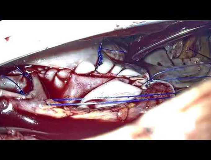 Sinus Venosus ASD Through MICS