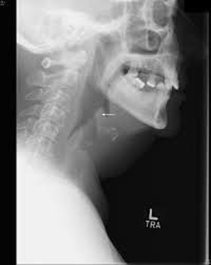 Risk factors of acute epiglotittis