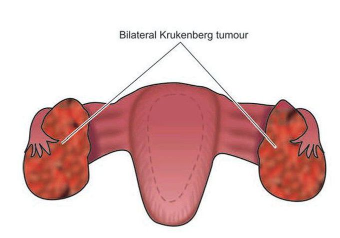 Krukenberg tumour