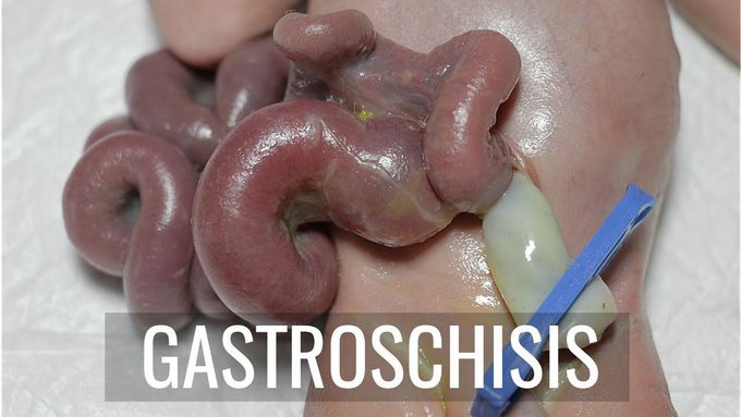Gastroschisis Case Study
