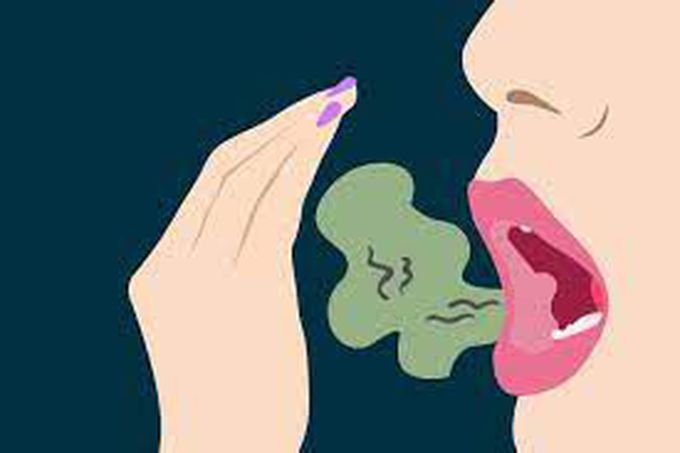 Bad Breath (Halitosis)