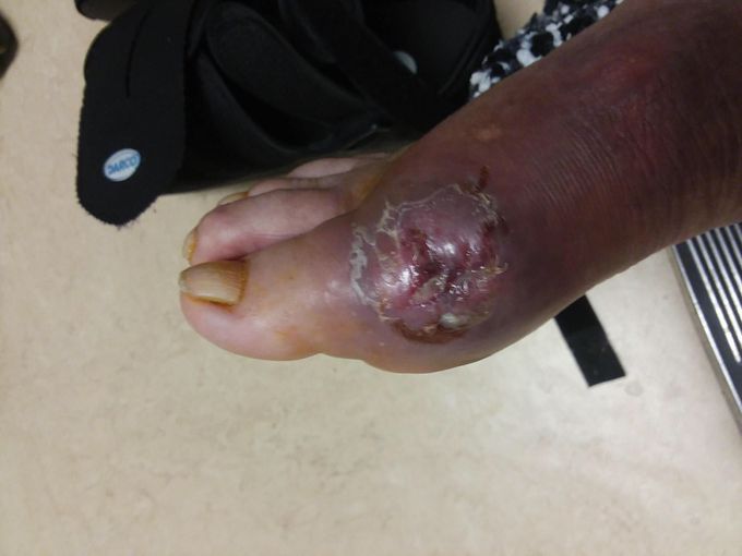Post operative