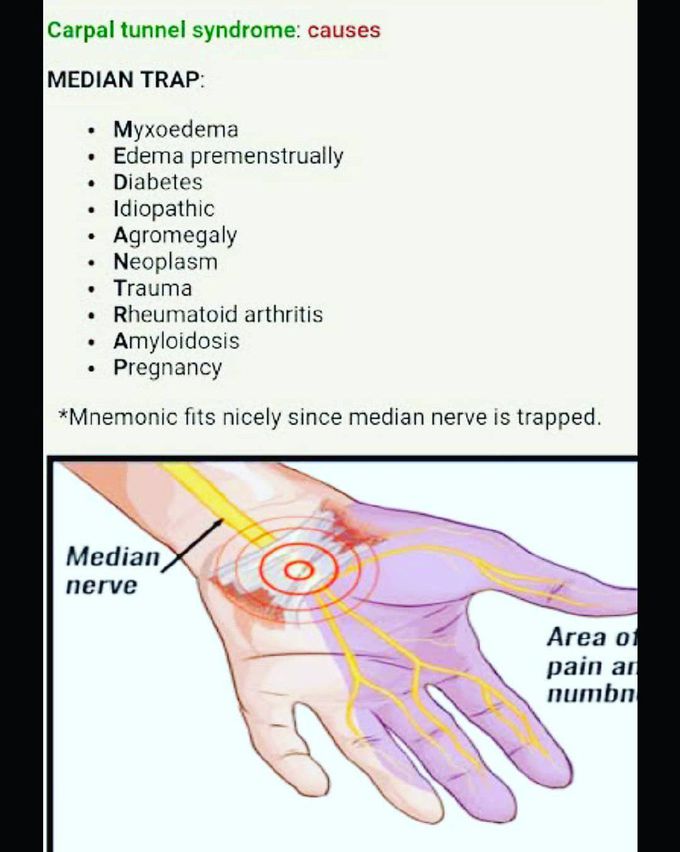 Causes of carpal tunnel syndrome