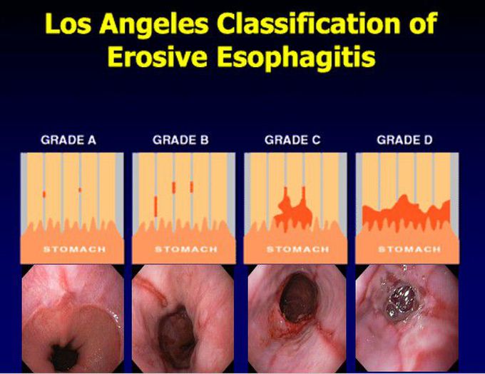 Los Angeles Classification