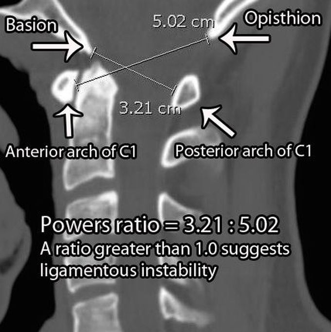 Occipitocervical dislocation - MEDizzy