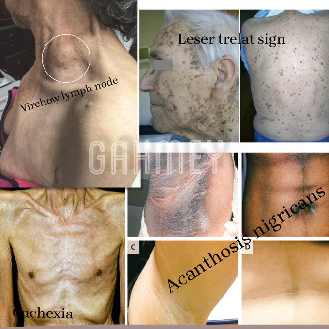 Gastric Carcinoma