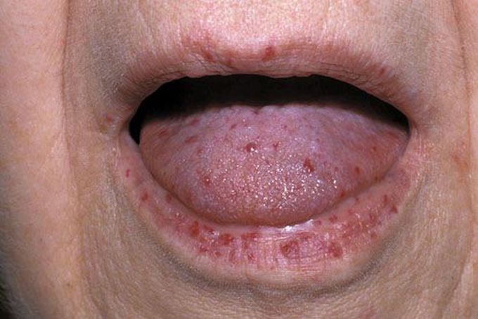 Hereditary Hemorrhagic Telangiectasia