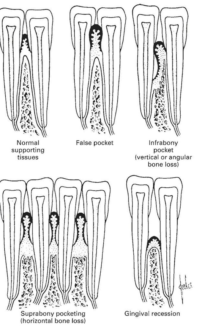 Pocket formation in periodontal disease