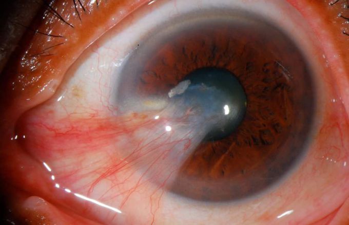 Pterygium