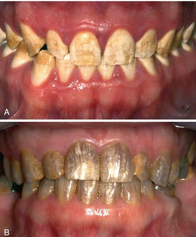 Hypomaturation Amelogenesis Imperfecta, X-Linked.