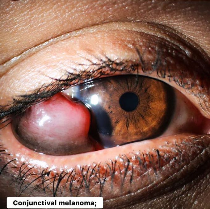 Conjunctival melanoma