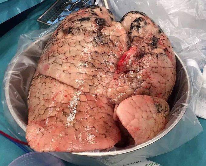 Smoker's lung for transplant